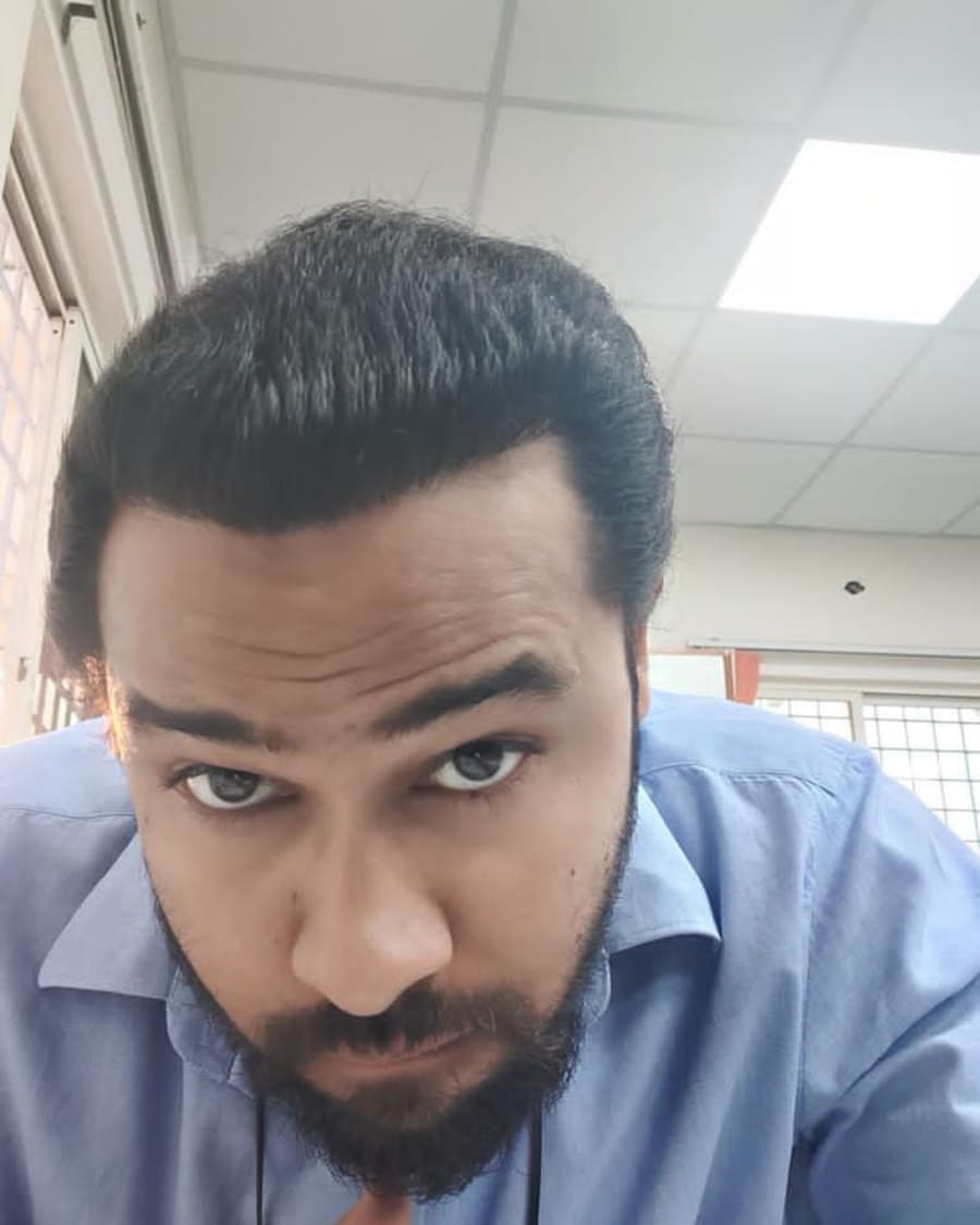 Rinova patient hair transplant result — after treatment