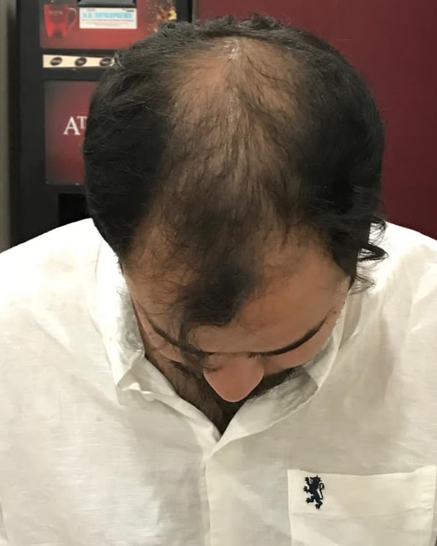 Rinova patient hair transplant result — before treatment