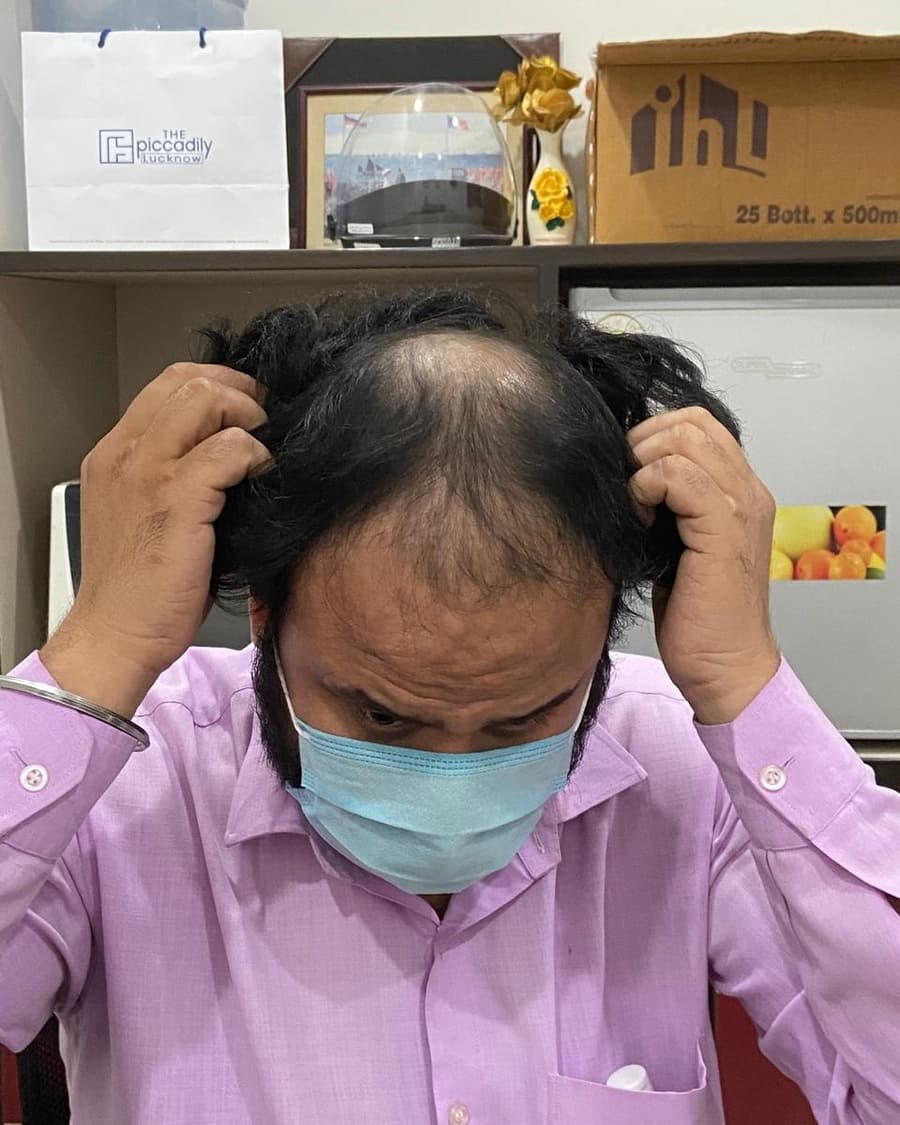 Rinova patient hair transplant result — before treatment
