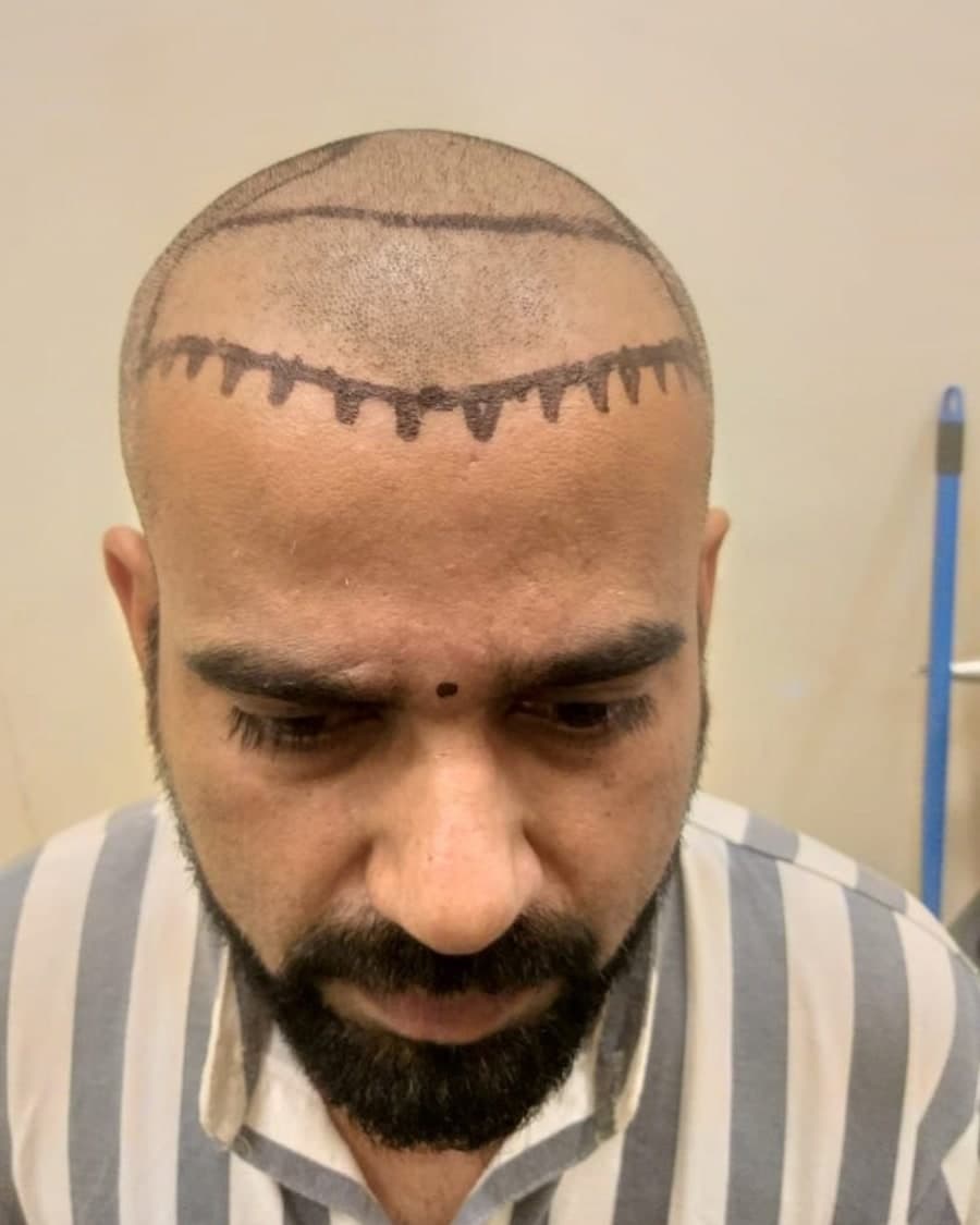 Rinova patient hair transplant result — before treatment