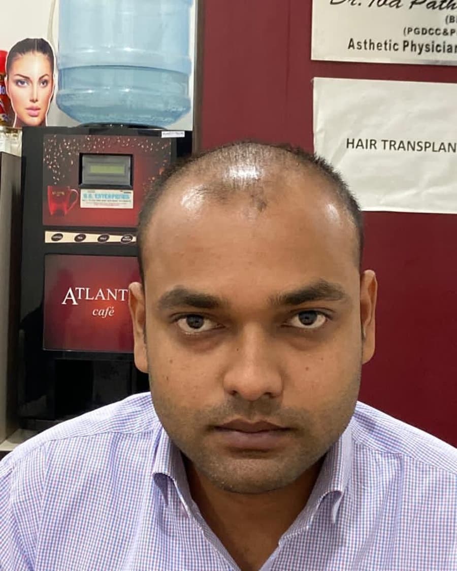 Rinova patient hair restoration result — before treatment