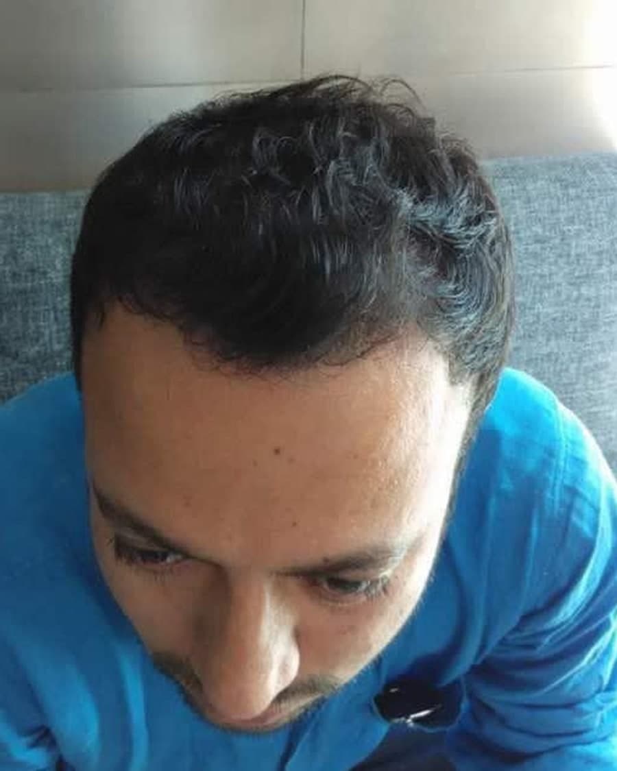 Rinova patient hair restoration result — after treatment