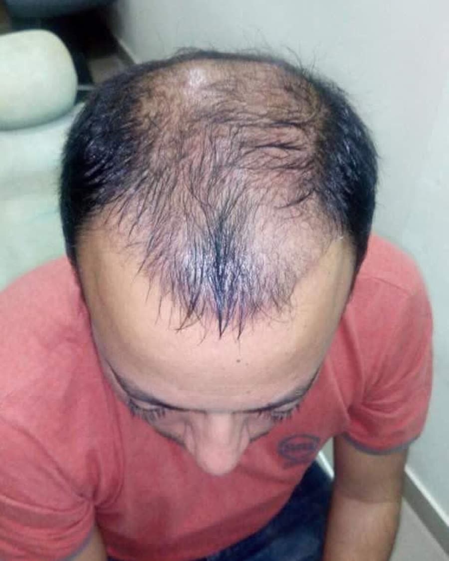 Rinova patient hair restoration result — before treatment