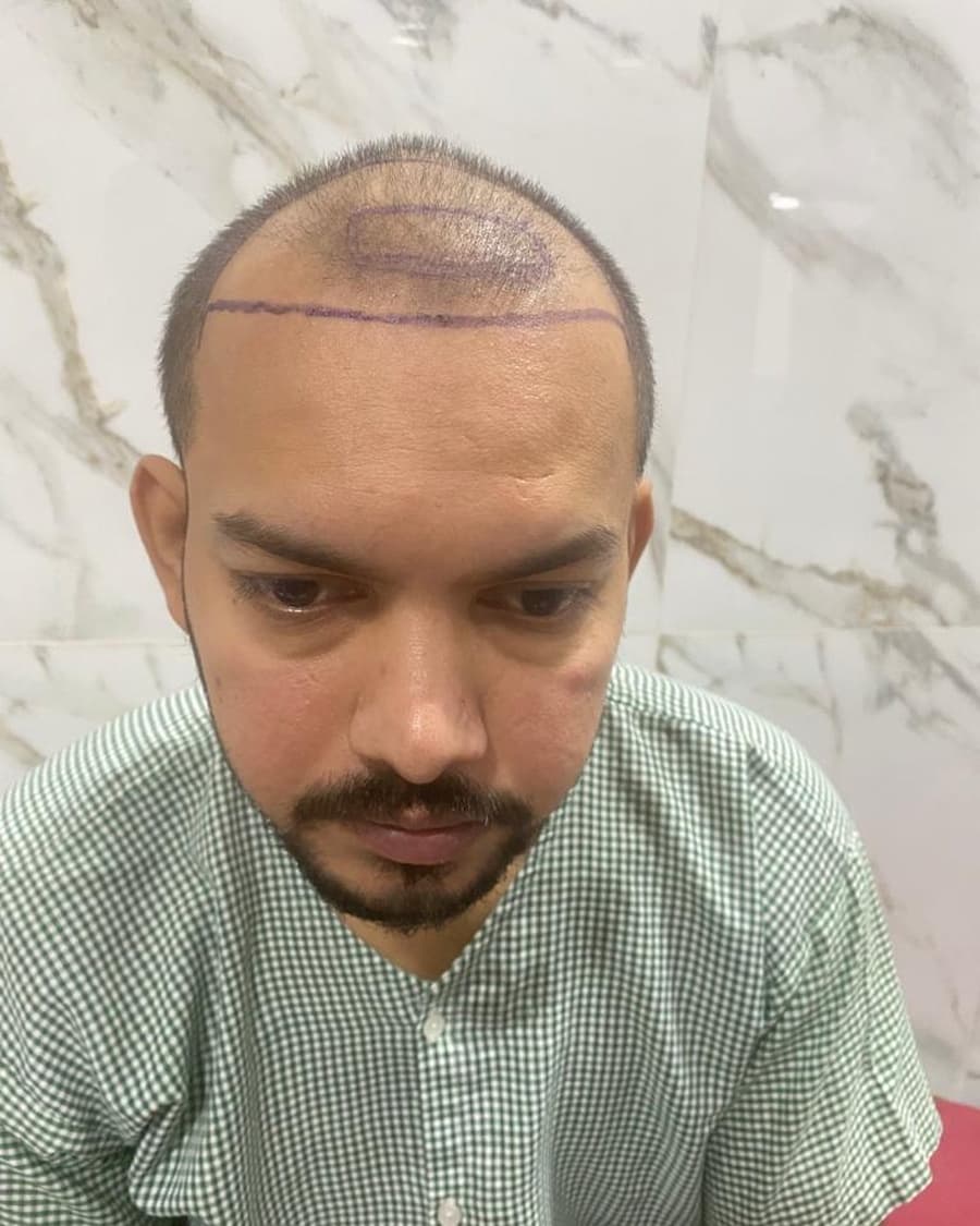Rinova patient hair restoration result — before treatment